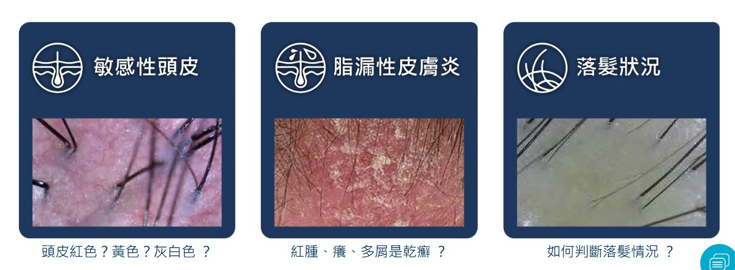 敏感性頭皮、脂漏性皮膚炎、落髮狀況高清圖